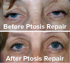 oculoplastic surgery ptosis types repair