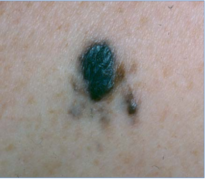 Three Types of Skin Cancers - Starling Physicians