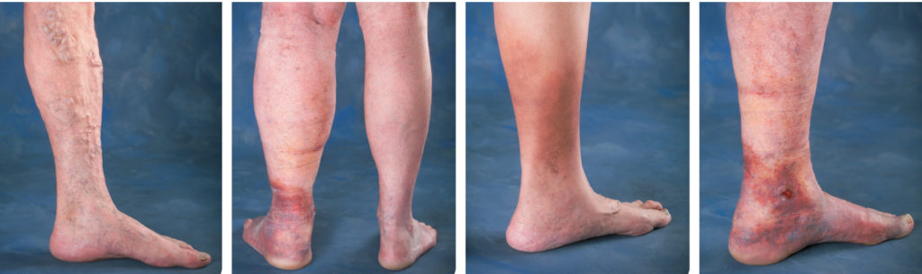 Understanding Leg Vein Problems  Vein Specialist & Treatment in